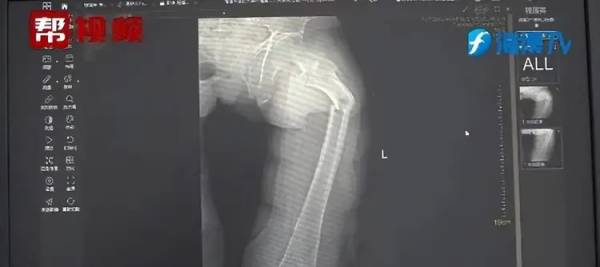 Viral! Pria Alami Patah Tulang Paha saat Batuk, Kondisinya Bikin Dokter Bingung